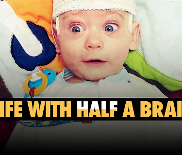 Life with Half a Brain (2024)