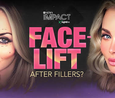 IMPACT x Nightline: Facelift: After Fillers?