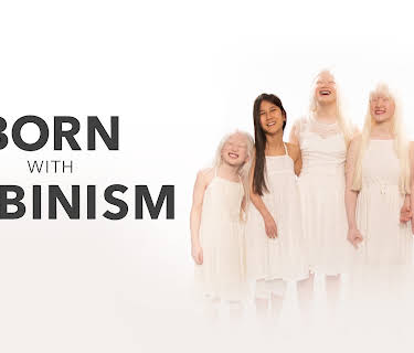 Born With Albinism