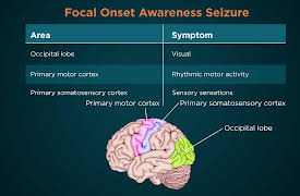 Understanding Disorders of the Brain: Epilepsy