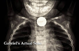 Monsters Inside Me: Worms Are Eating My Lungs