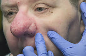 Save My Skin: This Is a Big One!