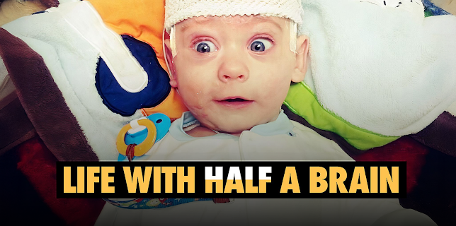 Life with Half a Brain (2024)