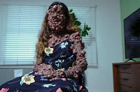Take My Tumor, Season 1: The Woman Covered in Thousands of Tumors