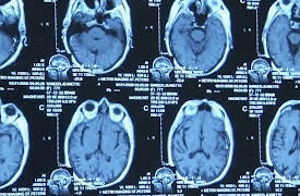 The Alzheimer's Project: Season 1: The Alzheimer's Project: Momentum in Science (Part 1)