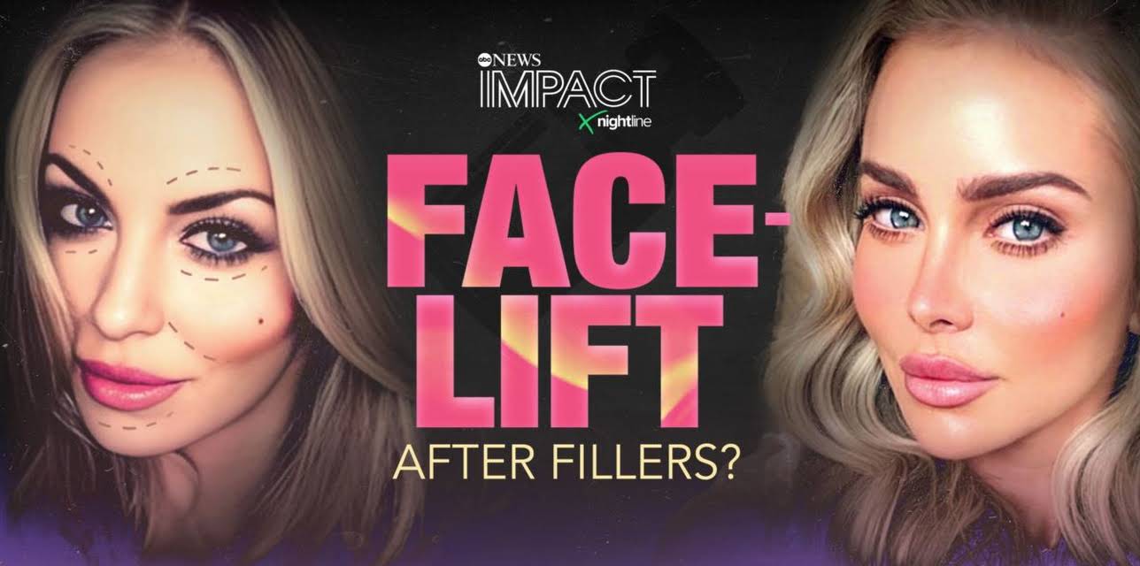IMPACT x Nightline: Facelift: After Fillers?