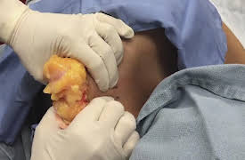 Dr. Pimple Popper: This is Zit: A Life-changing Lipoma Removal