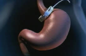 Alan Alda in Scientific American Frontiers, Season 15: Surgical Slimmers