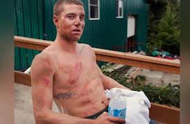 King Of The Road Season 1: Possible Broken Cheekbone