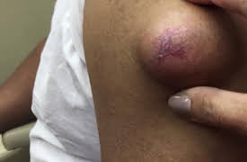 Dr. Pimple Popper: This is Zit: Tackling an Epidermoid Cyst