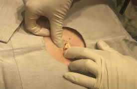 Dr. Pimple Popper: This is Zit: A Persistent Cyst