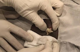 Dr. Pimple Popper: This is Zit: A Little Epidermoid Cyst