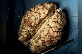 The Neuroscience of Addiction: The Human Brain