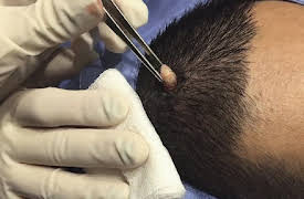 Dr. Pimple Popper: This is Zit: A Pilar Cyst and a Blackhead