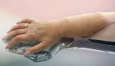 Die neue Hand - Geschichte einer Transplantation