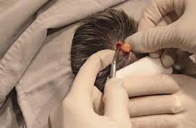 Dr. Pimple Popper: This is Zit: A Headstrong Pilar Cyst