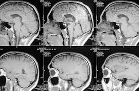 Understanding the Brain: Cortex—Sensory, Motor, and Association Areas