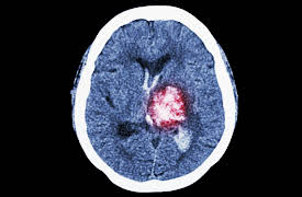 Understanding the Brain: Stroke