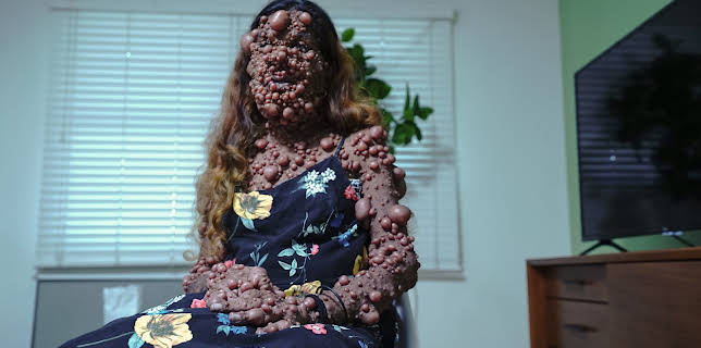 22:21: Tumores extremos | DKISS | 1/17 2026