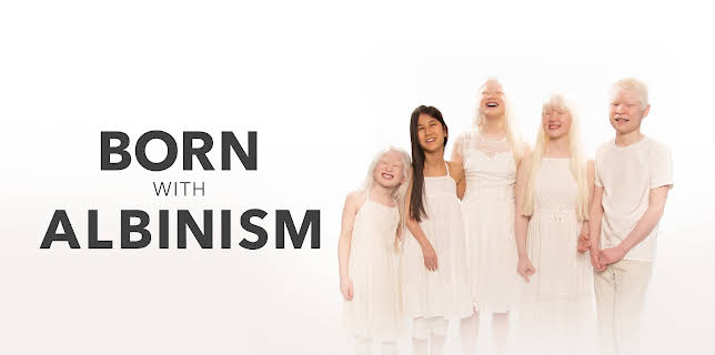 Born With Albinism