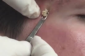 Dr. Pimple Popper: This is Zit: Bye Bye Blackheads